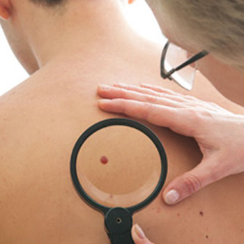 skin cancer services