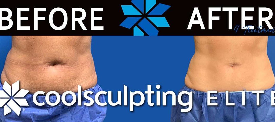 How CoolSculpting Elite Can Help You Have A Hot Summer